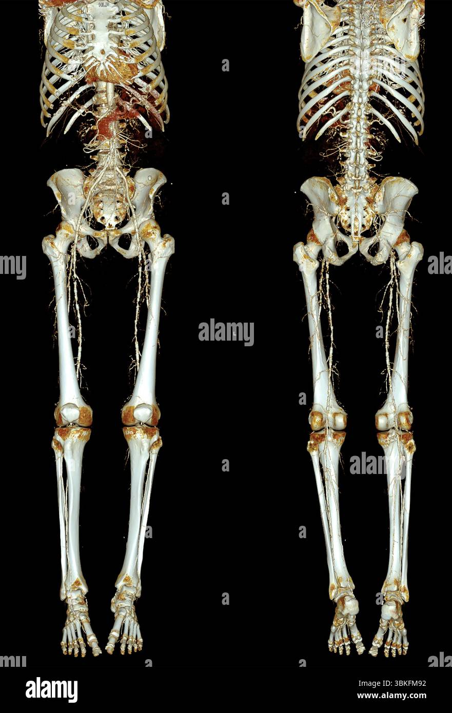 Farbige 3D-Computertomographie (CT)-Angiogramm-Scans der unteren Extremitäten mit arterieller Verengung und Verkalkung. Stockfoto