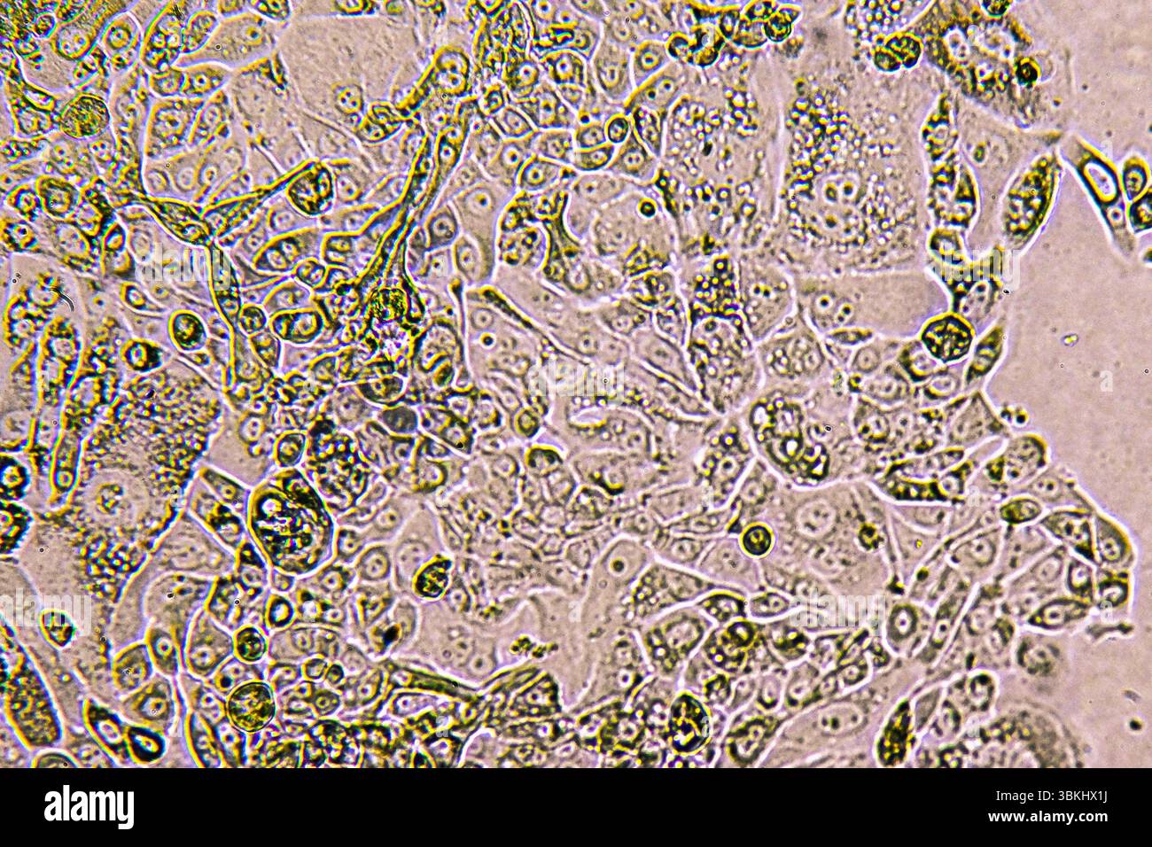 Glioblastom-Zellkultur. Humane Gliomzellen unter Vergrösserung. Stockfoto