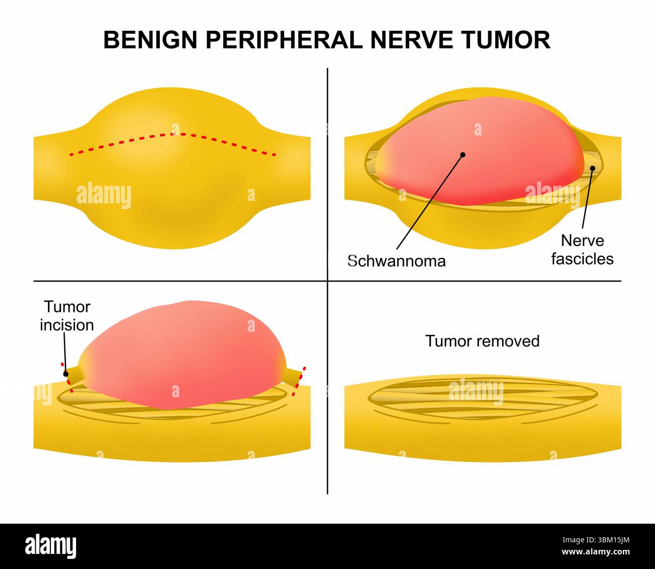 Gutartiger peripherer Nerventumor Stockfoto