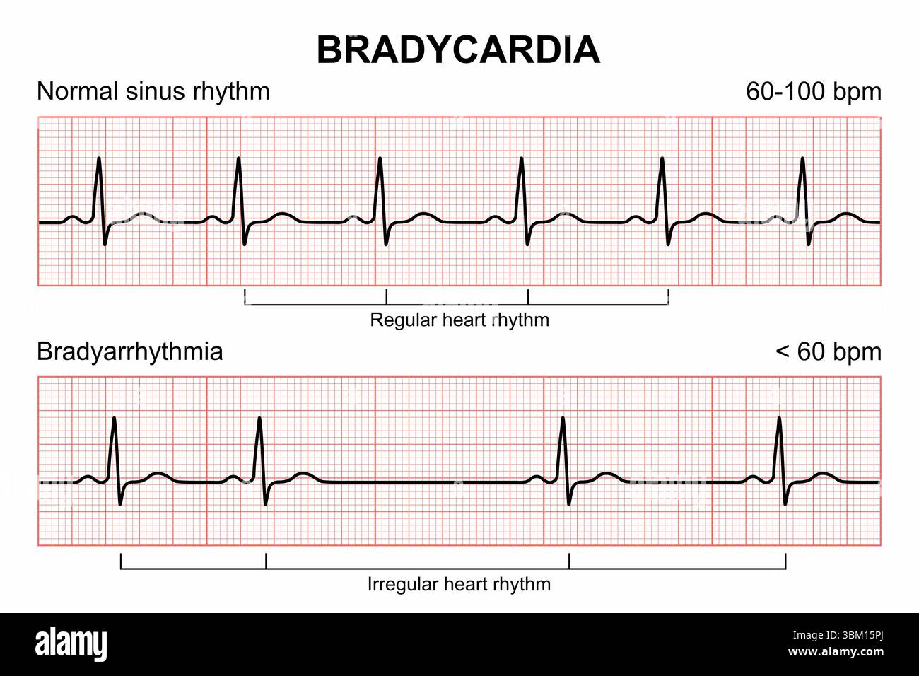 Bradykardie Stockfoto