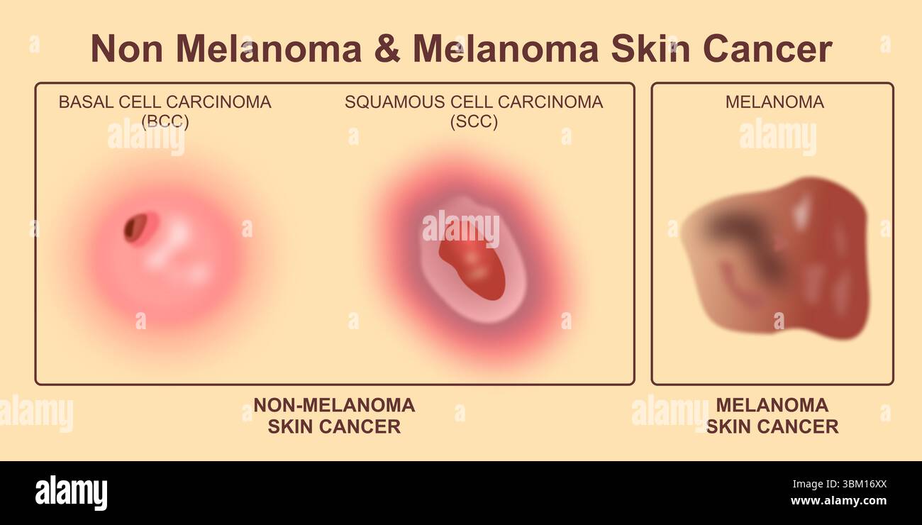 Nichtmelanom Und Melanomhautkarzinom Stockfoto