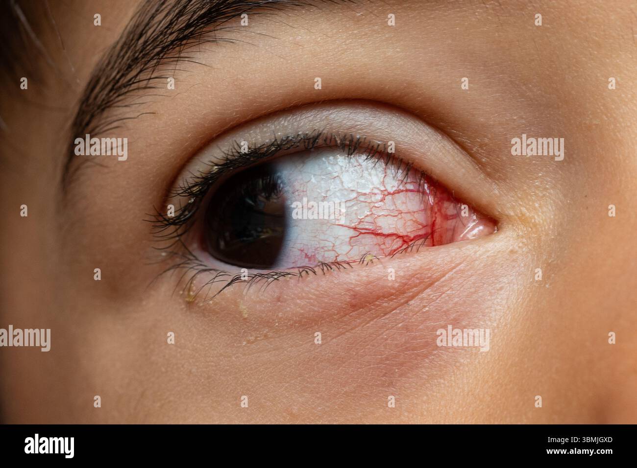 Nahaufnahme roter Augen mit Kapillaren und Irritationen, Augenallergie, Konjunktivitis Stockfoto