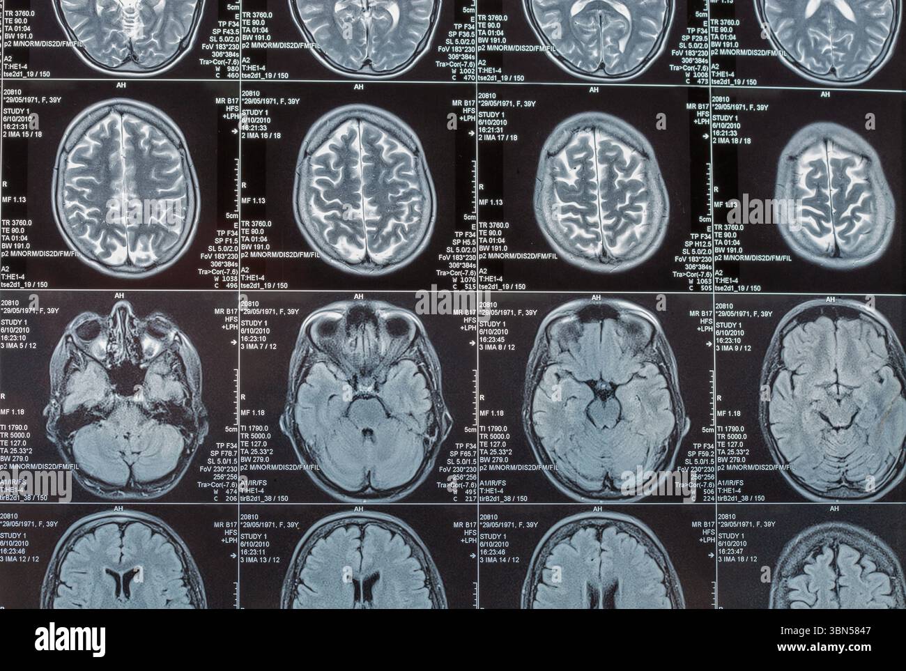 Magnetresonanztomographie oder MRT-Bild der Hirnnahmebildung Stockfoto