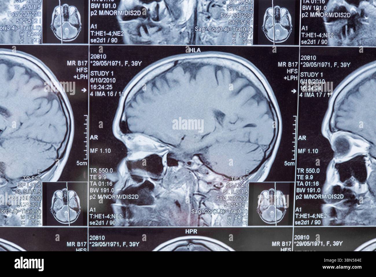 Magnetresonanztomographie oder MRT-Bild der Hirnnahmebildung Stockfoto