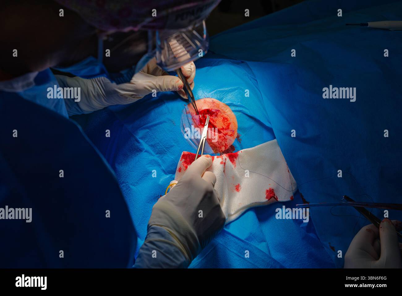 Dermatologische Chirurgie im OP. Die Naht einer chirurgischen Wundverletzung. Plattenepithelkarzinom. Die Hände eines Chirurgen und seiner Assistentin Stockfoto