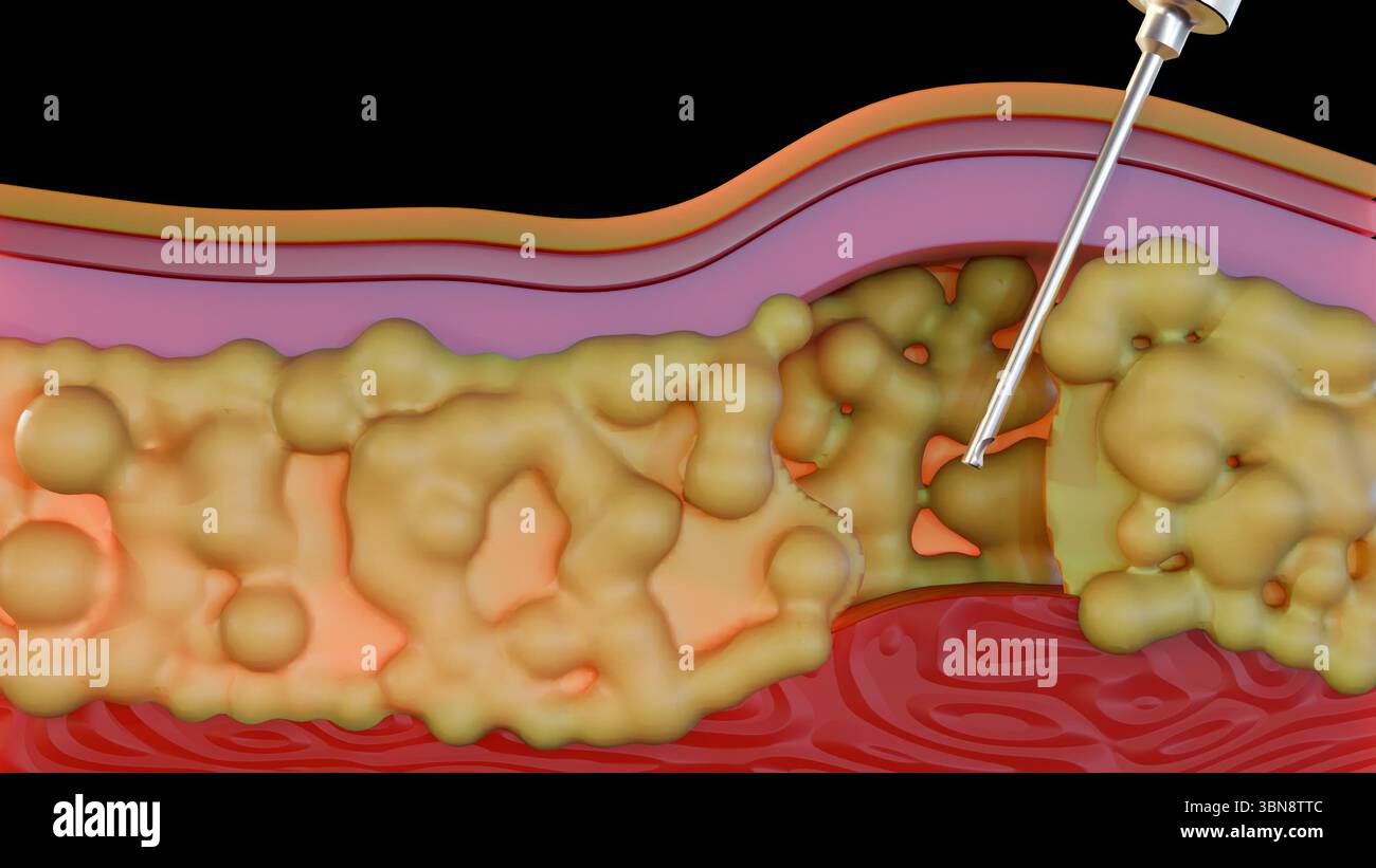 Ein 3D-Rendering, das den Prozess der Fettabsaugung veranschaulicht und insbesondere zeigt, dass eine Kanüle aktiv Fett aus der subkutanen Schicht entfernt. Stockfoto
