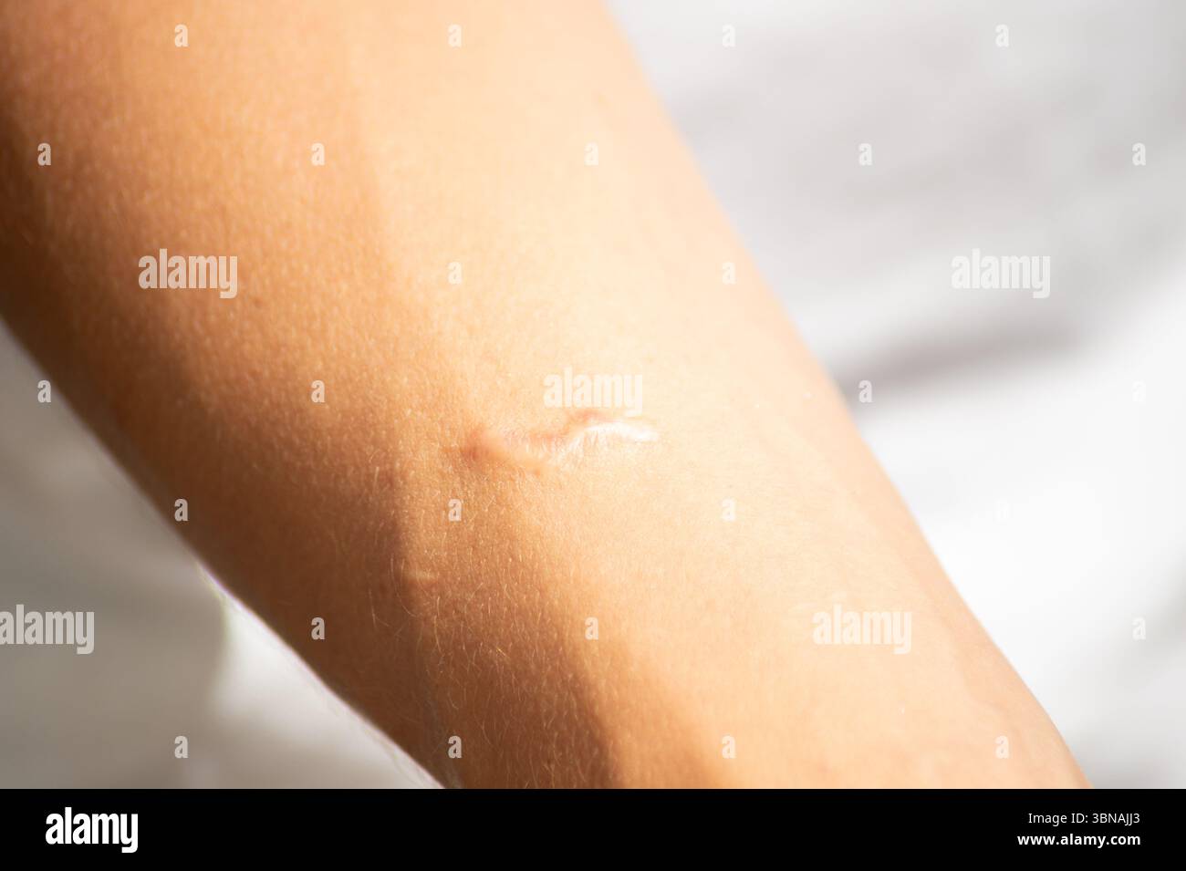 Eine auffällige Narbe am Arm eines Mannes, die die Textur und den Heilungsprozess hervorhebt. Steht für Resilienz, frühere Erfahrungen oder dermatologische Konzepte. Stockfoto