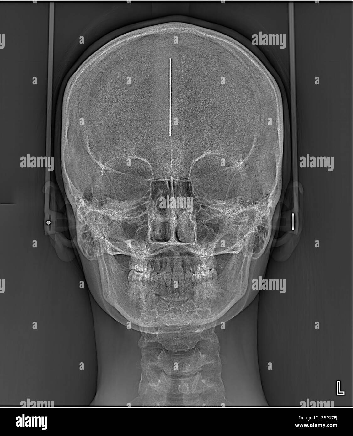 Detailliertes Röntgenbild eines menschlichen Schädels, das die komplexe Struktur und Anordnung von Gesichtsknochen und Schädelhöhle für medizinische Analysen und zeigt Stockfoto