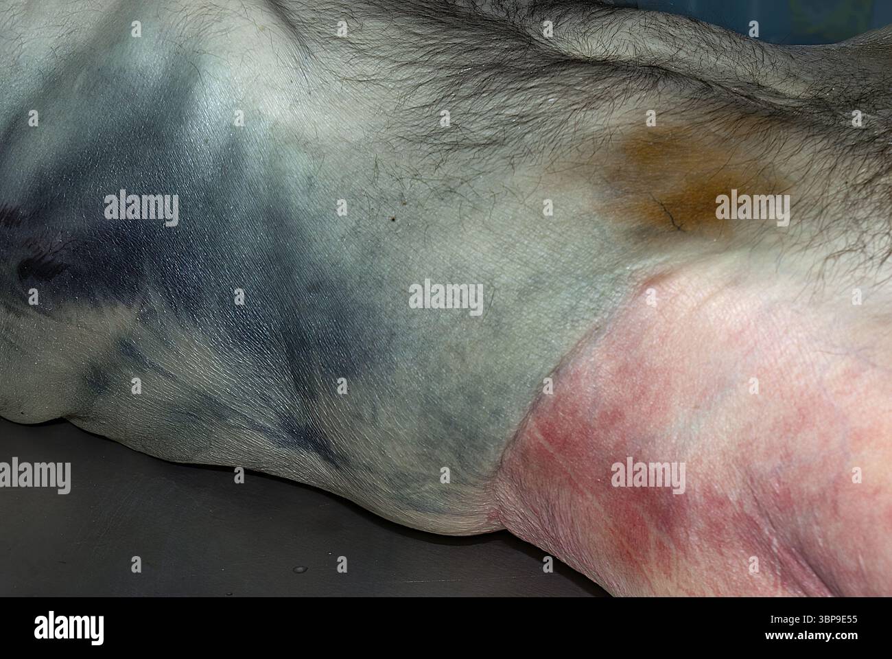 Postmortale Livor-Mortis-Verfärbung auf menschlicher Haut - Forensische Pathologie-Evidenz Stockfoto