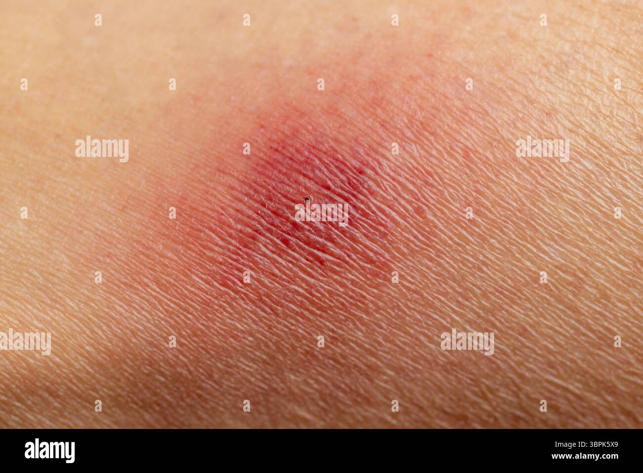 Lyme-Borreliose ist eine bakterielle Infektion, die auf den Menschen durch den Biss von infizierten Zecken verbreitet wird. Der Hautausschlag wird oft als kreisförmiger Hautausschlag beschrieben. Stockfoto