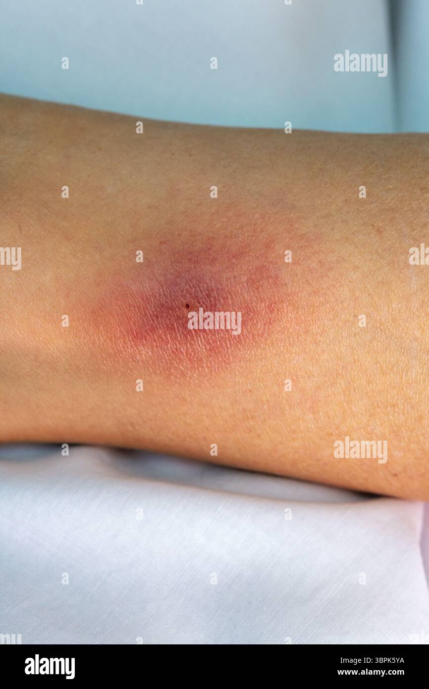 Lyme-Borreliose ist eine bakterielle Infektion, die auf den Menschen durch den Biss von infizierten Zecken verbreitet wird. Der Hautausschlag wird oft als kreisförmiger Hautausschlag beschrieben. Stockfoto
