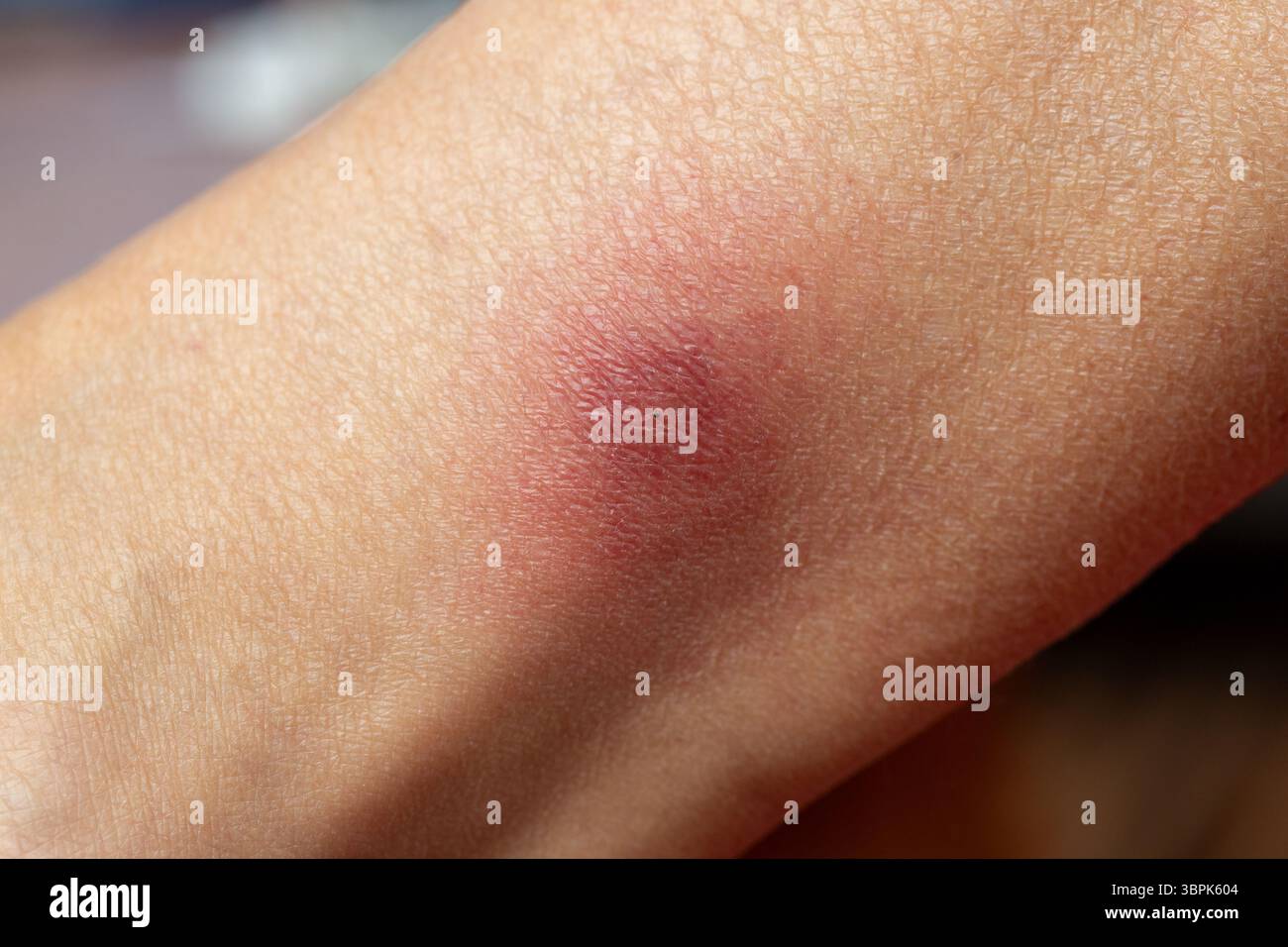 Lyme-Borreliose ist eine bakterielle Infektion, die auf den Menschen durch den Biss von infizierten Zecken verbreitet wird. Der Hautausschlag wird oft als kreisförmiger Hautausschlag beschrieben. Stockfoto