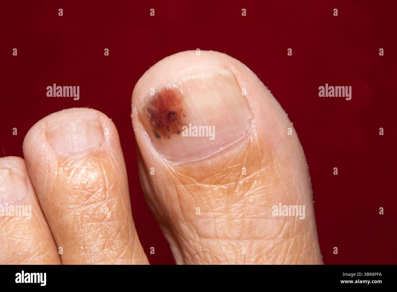 Nahaufnahme eines blauen großen Zehens mit sichtbaren subungualen Blutergüssen unter dem Zehennagel, die Verfärbungen und Traumata zeigen, die häufig durch Aufprall oder Druck verursacht werden Stockfoto