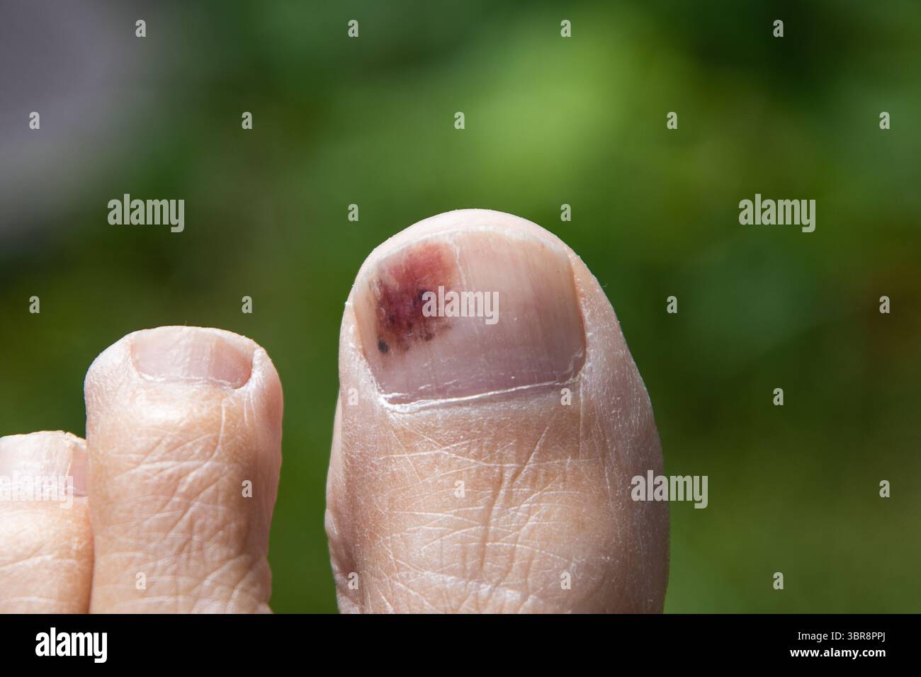Nahaufnahme eines blauen großen Zehens mit sichtbaren subungualen Blutergüssen unter dem Zehennagel, die Verfärbungen und Traumata zeigen, die häufig durch Aufprall oder Druck verursacht werden Stockfoto
