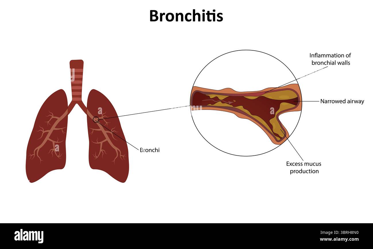 Bronchitis-Vektorillustration Stock Vektor
