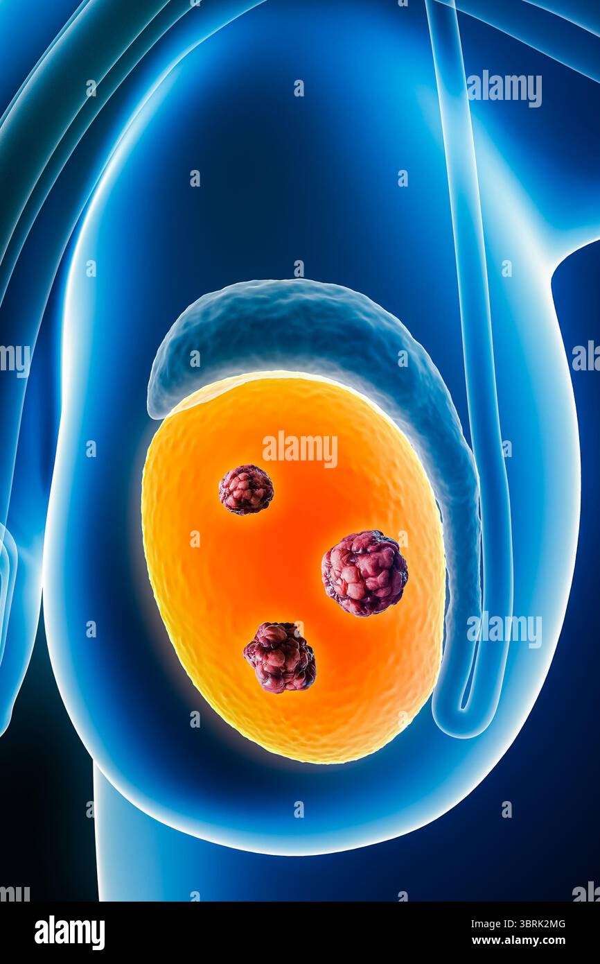 Röntgenologische Vorderansicht oder Vorderansicht menschlicher Hoden oder Hoden mit Krebszellen 3D-Darstellung mit Körperkonturen. Organ männlicher Fortpflanzungsorgane Stockfoto