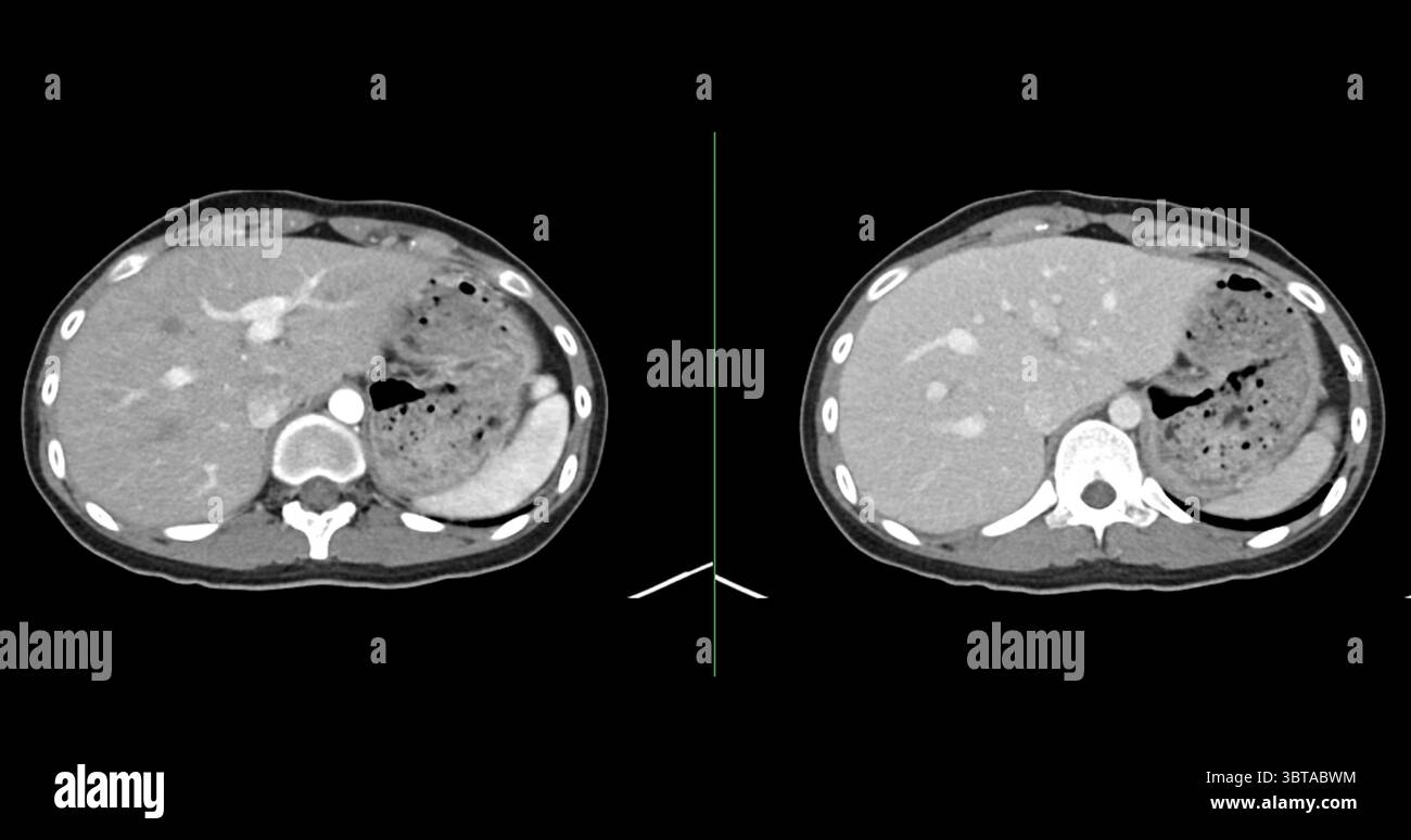 Kontrastmittelverstärkte CT-Studie des gesamten Abdomens, die normale anatomische Strukturen ohne Anzeichen einer Pathologie oder abnorme Flüssigkeitsansammlung aufweist. Stockfoto