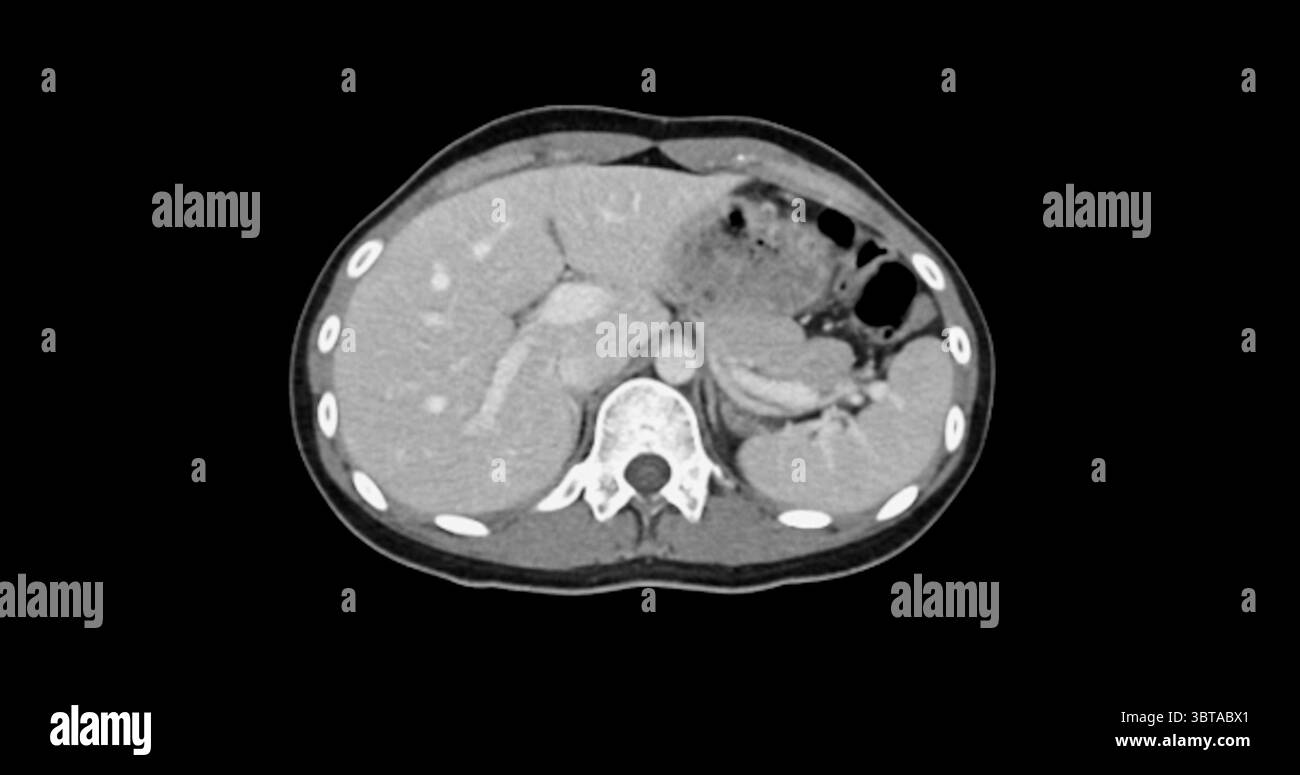 Kontrastmittelverstärkte CT-Studie des gesamten Abdomens, die normale anatomische Strukturen ohne Anzeichen einer Pathologie oder abnorme Flüssigkeitsansammlung aufweist. Stockfoto