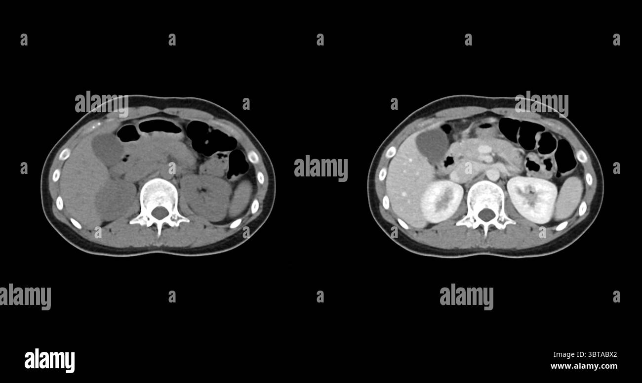 Kontrastmittelverstärkte CT-Studie des gesamten Abdomens, die normale anatomische Strukturen ohne Anzeichen einer Pathologie oder abnorme Flüssigkeitsansammlung aufweist. Stockfoto