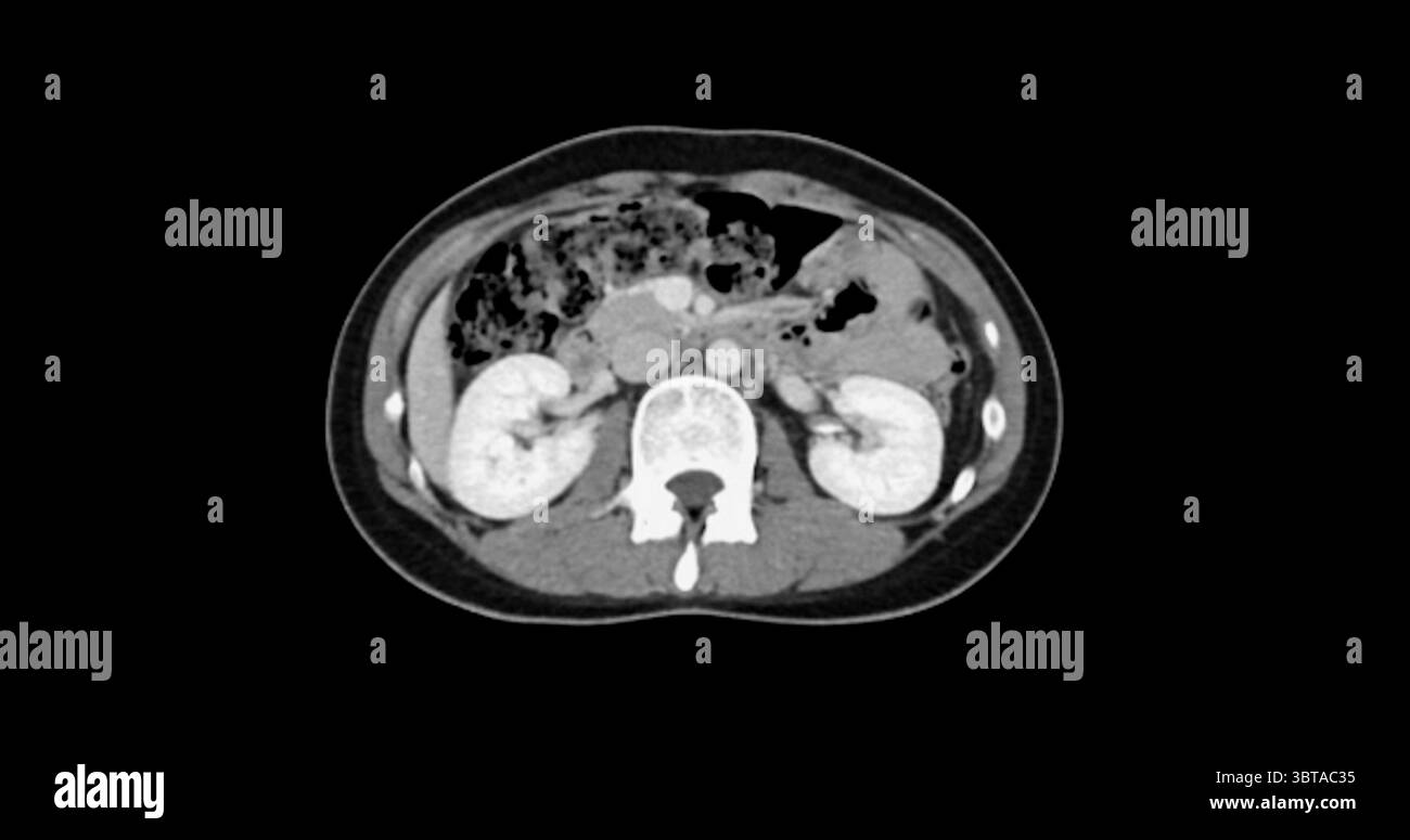 Kontrastmittelverstärkte CT-Studie des gesamten Abdomens, die normale anatomische Strukturen ohne Anzeichen einer Pathologie oder abnorme Flüssigkeitsansammlung aufweist. Stockfoto