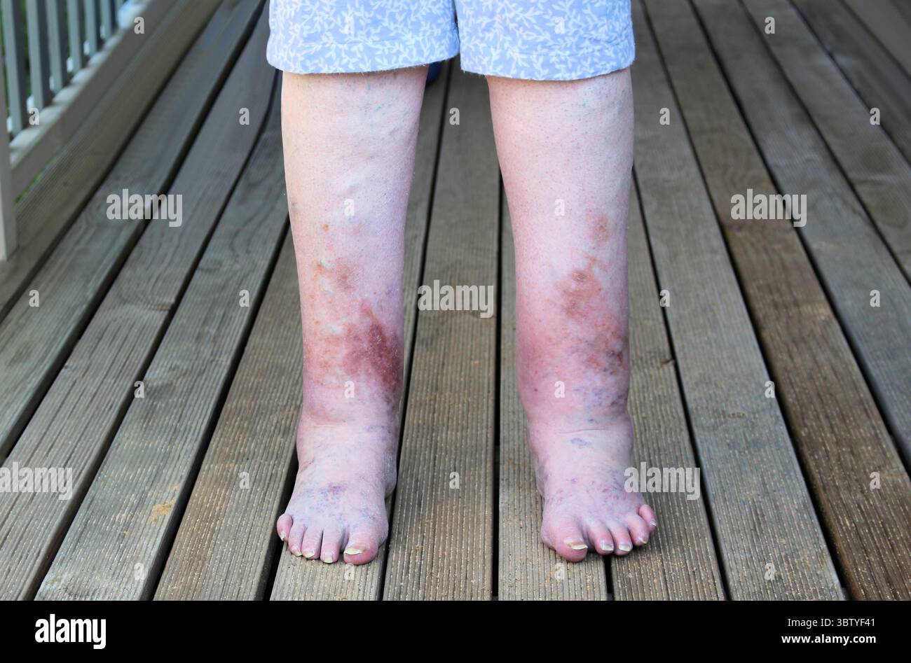 Unterschenkelödem und Hämosiderin-Färbung der Schienbeine bei 65-jähriger Frau. Stockfoto