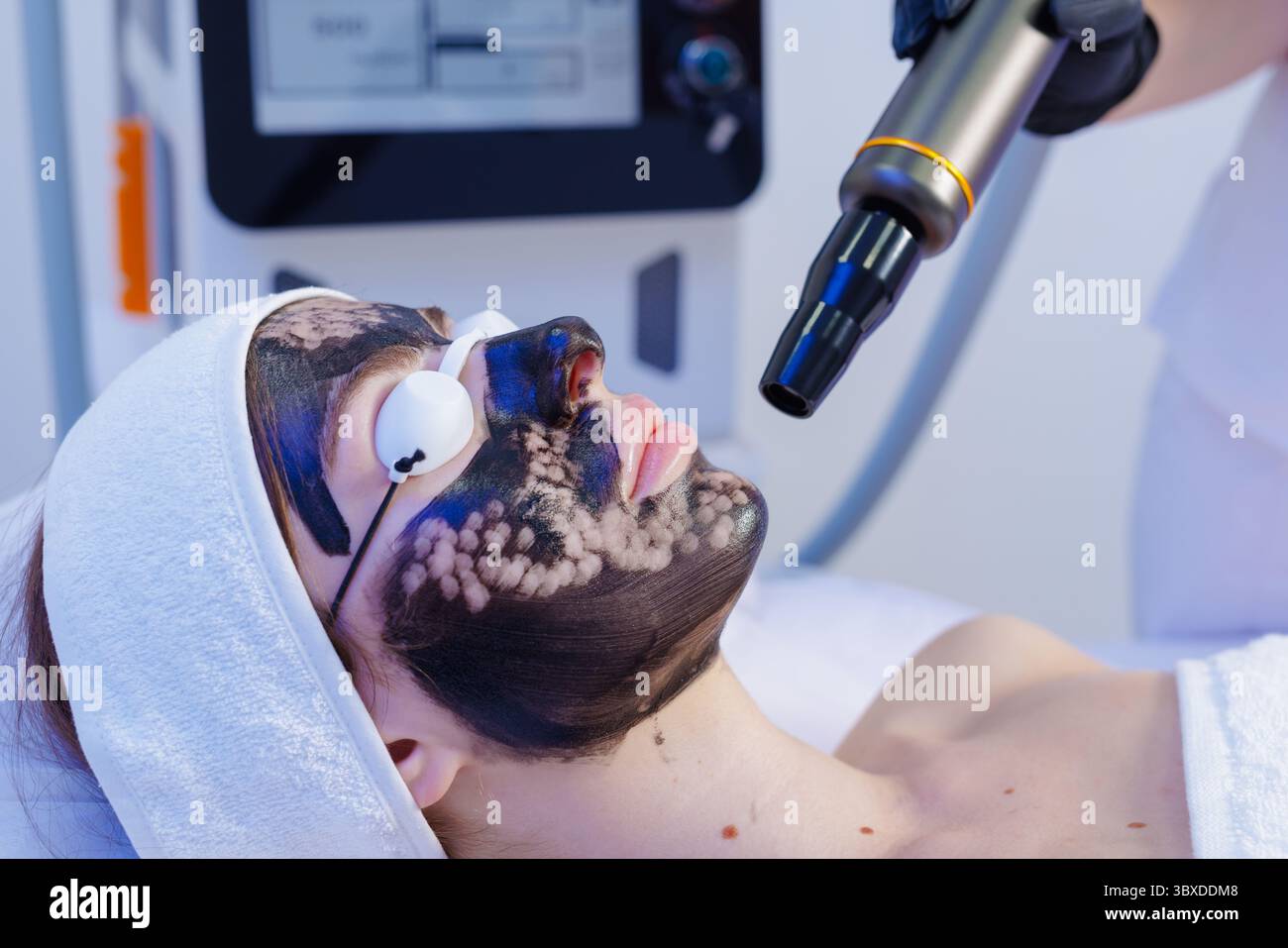 Nahaufnahme einer Laser-Kohlenstoff-Peeling-Behandlung zur Tiefenverjüngung und -Reinigung in einer professionellen Schönheitsklinik. Stockfoto