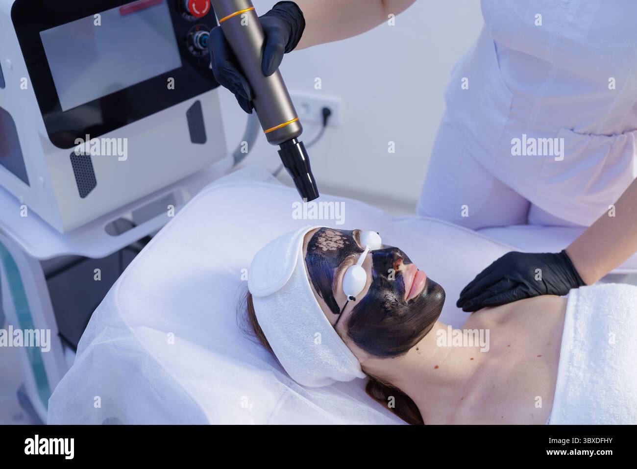 Laser-Kohlenstoff-Peeling-Verfahren zur fortgeschrittenen Gesichtsverjüngung, Tiefenreinigung und nicht-invasiven Schönheitsbehandlung. Stockfoto
