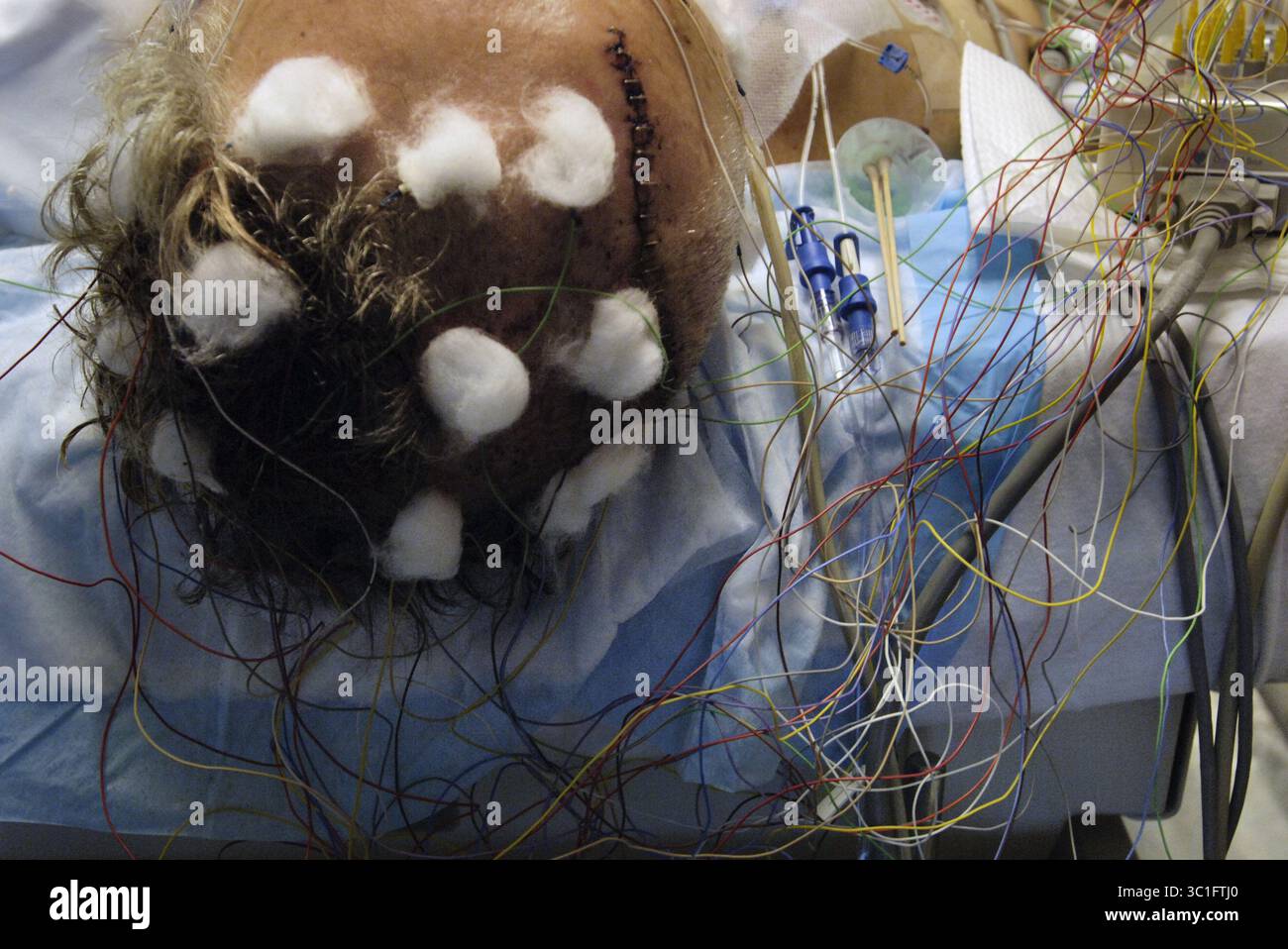 Jan 08, 2005 - Toronto, ON, KANADA - Ein Patient in wird einem EEG unterzogen, um seine Gehirnaktivität in der Critical Care Unit (CRCU) des Sunnybrook and Women's College Hospital zu erfassen. Der Test wurde einige Tage durchgeführt, nachdem er schwere Kopfverletzungen von einem Dach erlitten hatte. (Kreditbild: Rick Madonik/Minneapolis Star Tribune/TNS via ZUMA Wire) Stockfoto