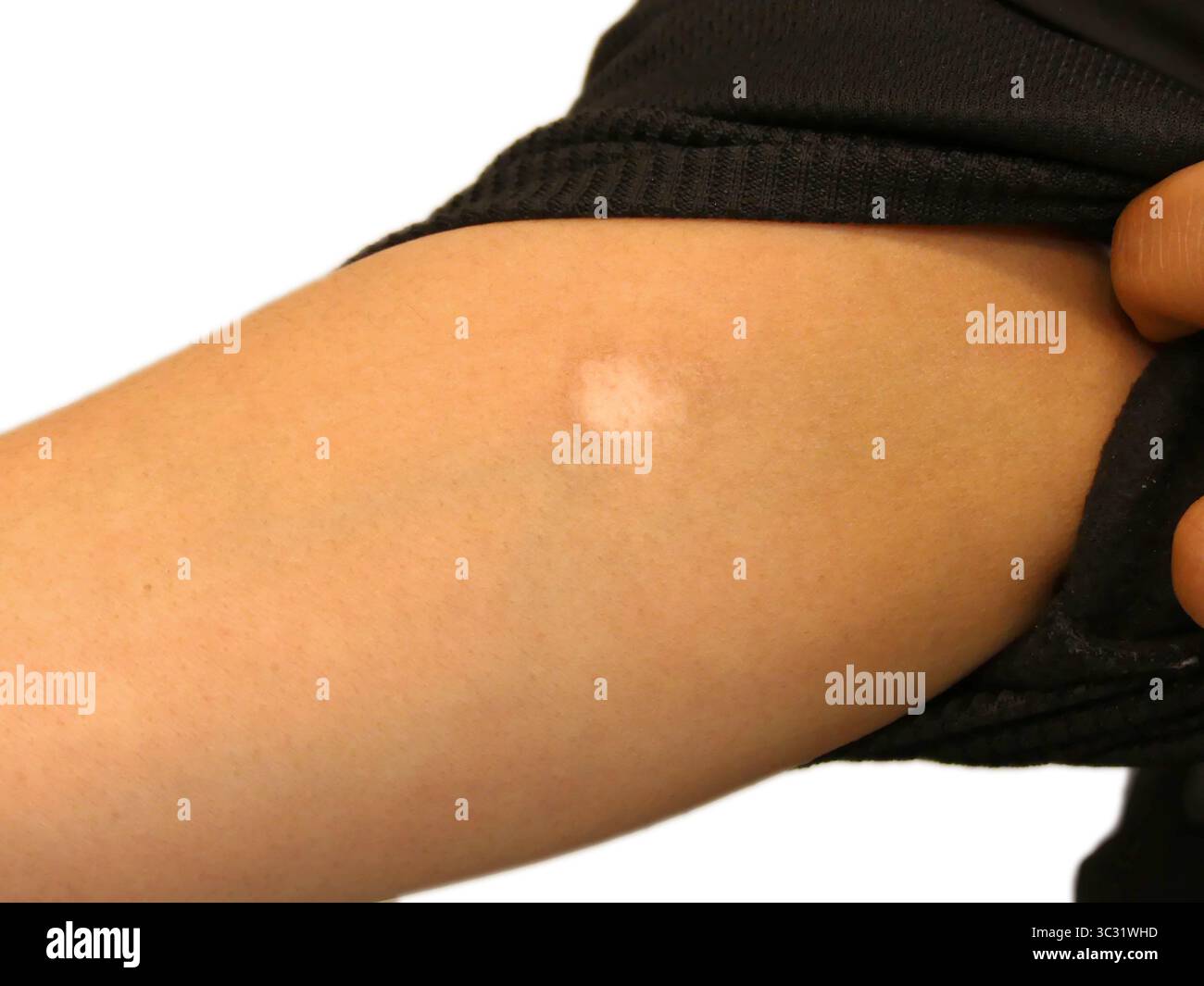 Nahaufnahme einer Zigarettenbrand-Narbe auf dem menschlichen Arm, die Selbstverletzung und psychische Gesundheit anzeigt Stockfoto
