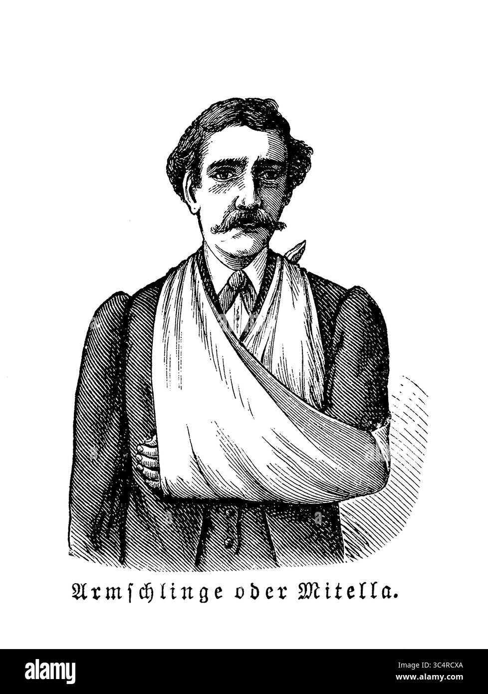 Orthopädie: Armschlinge aus Tuch als Bandage, um die Bewegung von Schulter und Ellenbogen zu begrenzen oder die Hand zu schützen, bis eine Verletzung heilt, Gravur aus dem 19. Jahrhundert Stockfoto