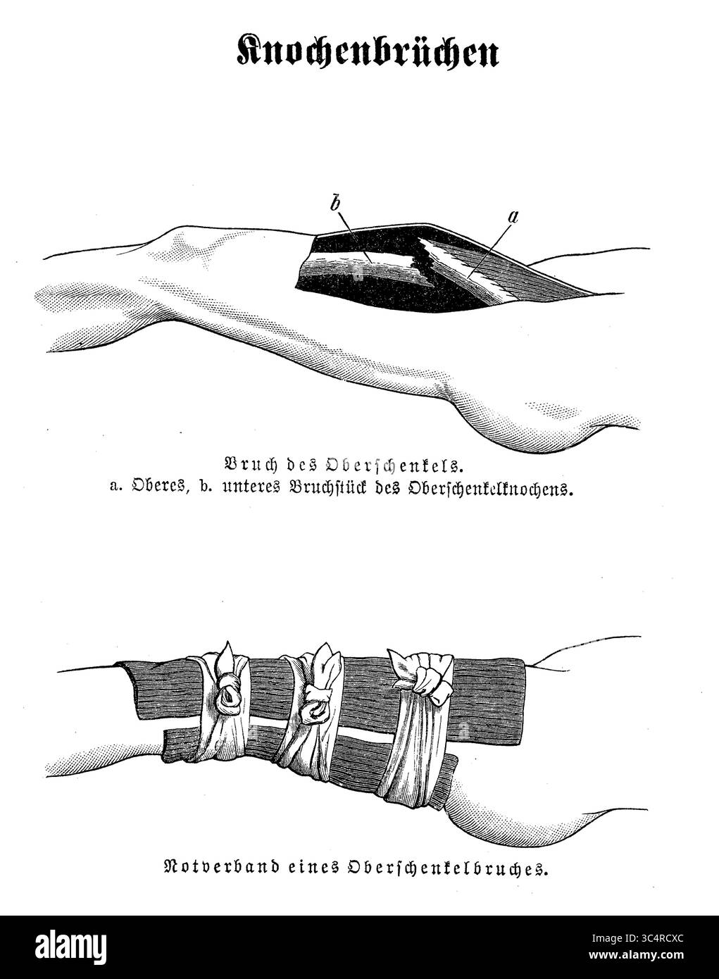 Orthopädie: Femurfraktur und Notfall-starre Bandage, Illustration des 19. Jahrhunderts Stockfoto