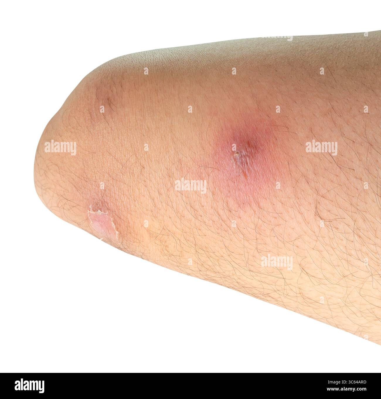 Abszess oberschenkel -Fotos und -Bildmaterial in hoher Auflösung – Alamy
