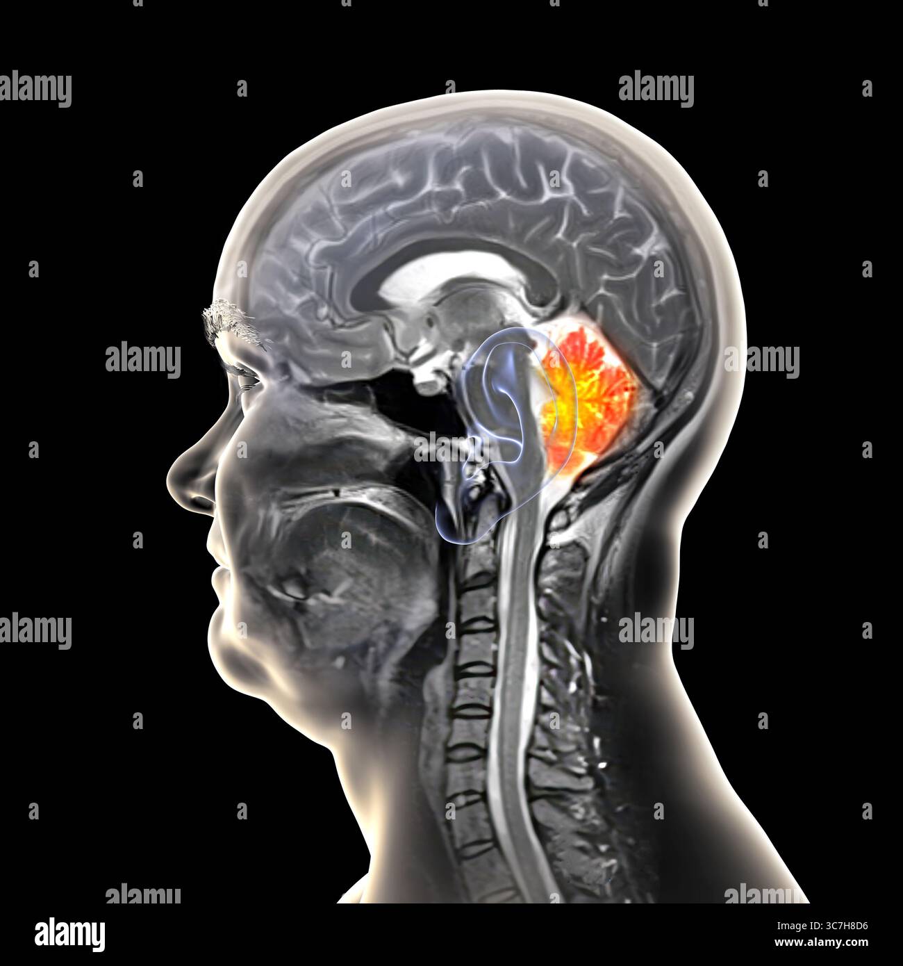 Abbildung einer farbigen Magnetresonanztomographie (MRT) des Gehirns, die das Kleinhirn zeigt. Diese Struktur umfasst Balance, Koordination und Motorsteuerung. Stockfoto