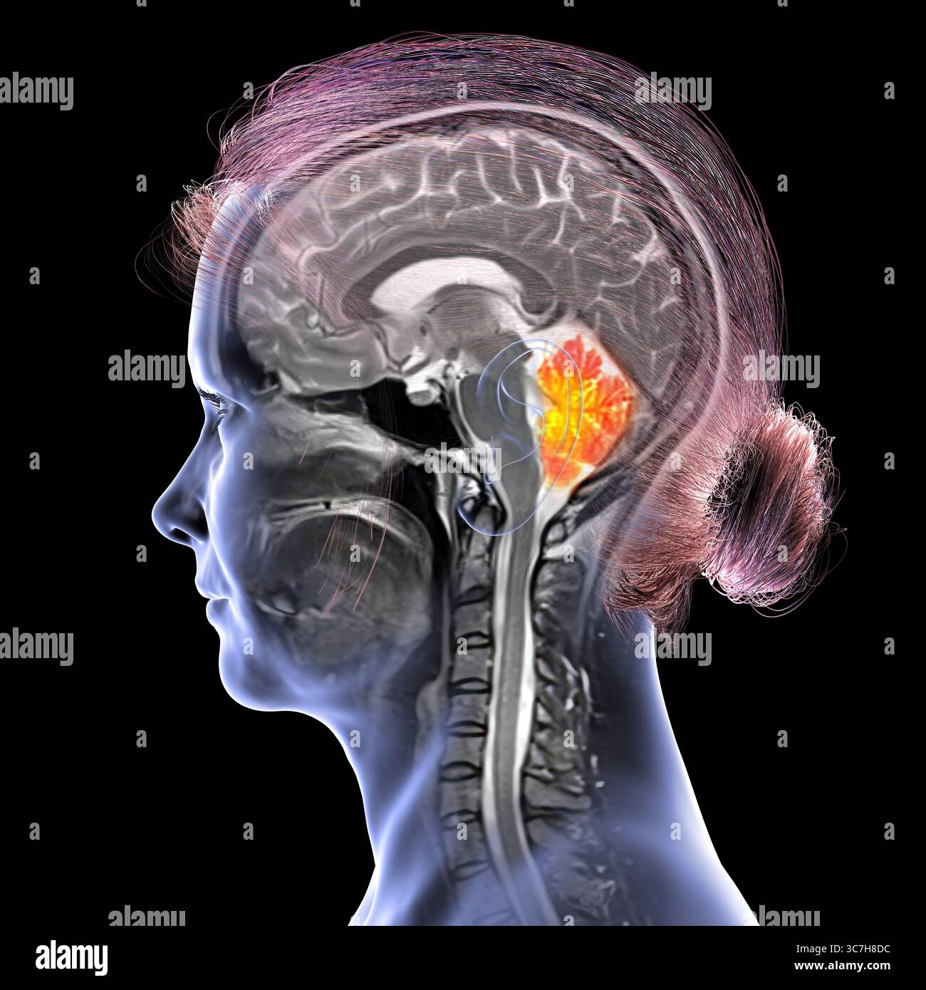 Abbildung einer farbigen Magnetresonanztomographie (MRT) des Gehirns, die das Kleinhirn zeigt. Diese Struktur umfasst Balance, Koordination und Motorsteuerung. Stockfoto