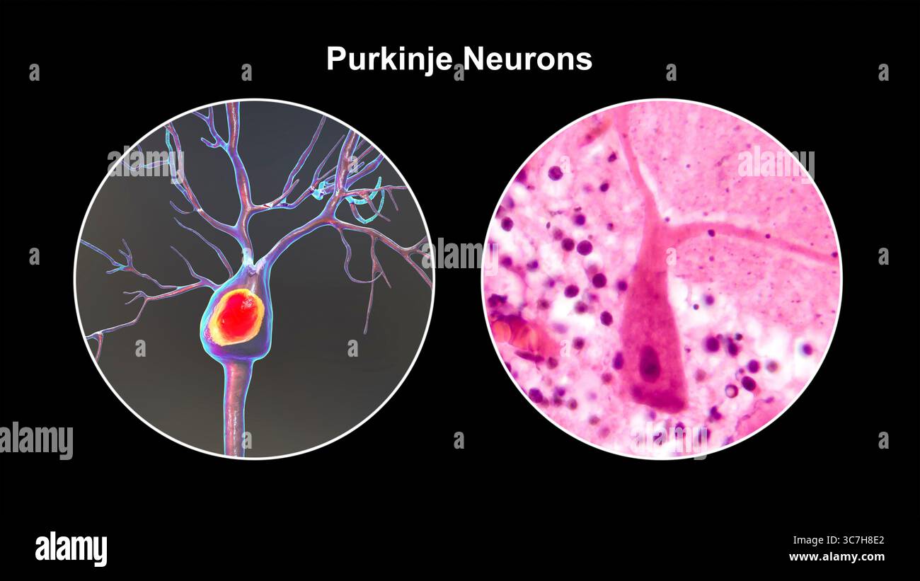 Illustration von Purkinje-Neuronen und eine Lichtmikrographie, die große, verzweigte Neuronen in der Kleinhirnrinde zeigt, die an der motorischen Koordination beteiligt sind und an Ataxien beeinflusst sind. Stockfoto