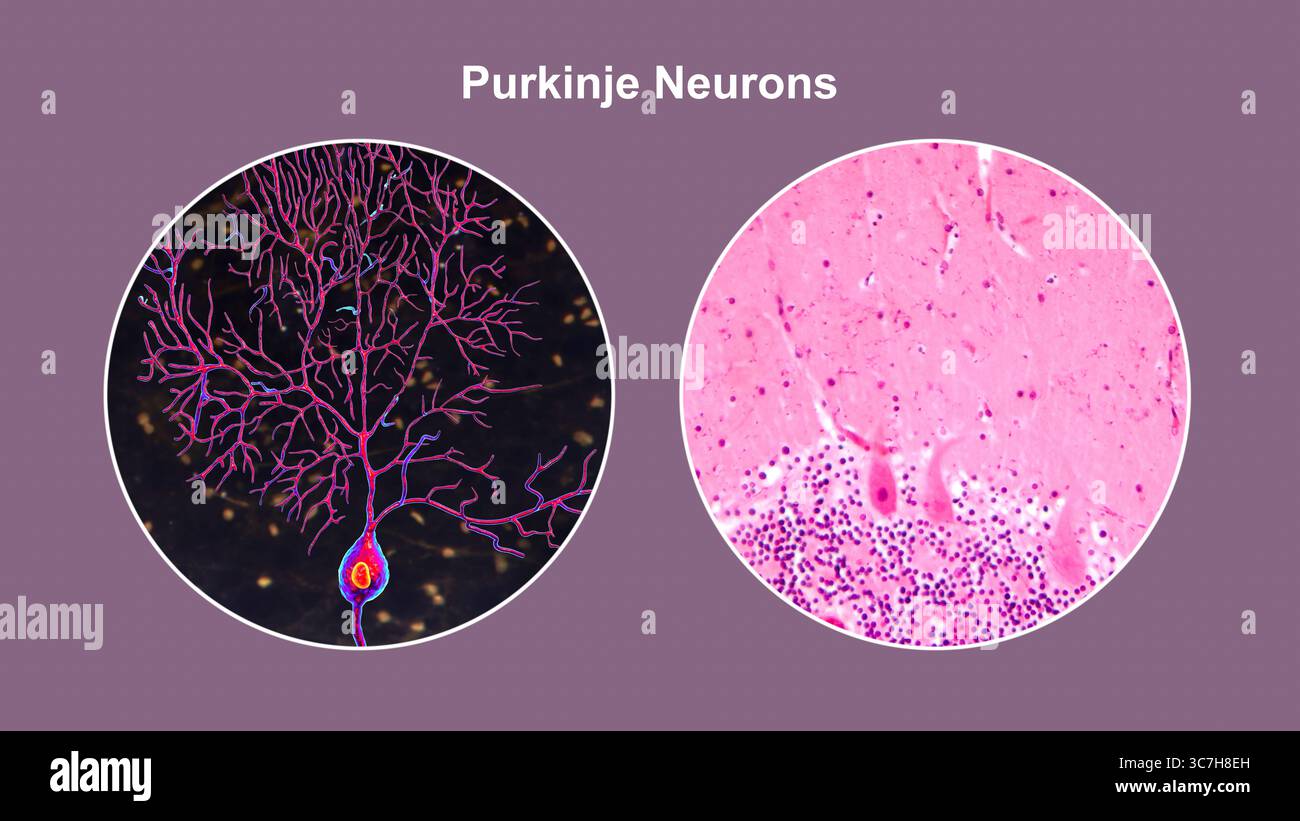 Illustration von Purkinje-Neuronen und eine Lichtmikrographie, die große, verzweigte Neuronen in der Kleinhirnrinde zeigt, die an der motorischen Koordination beteiligt sind und an Ataxien beeinflusst sind. Stockfoto