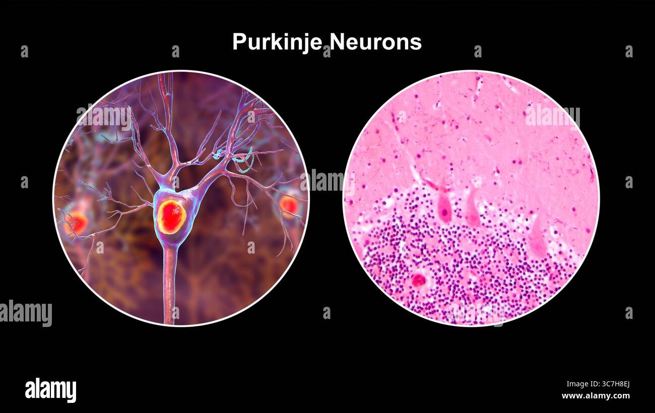 Illustration von Purkinje-Neuronen und eine Lichtmikrographie, die große, verzweigte Neuronen in der Kleinhirnrinde zeigt, die an der motorischen Koordination beteiligt sind und an Ataxien beeinflusst sind. Stockfoto