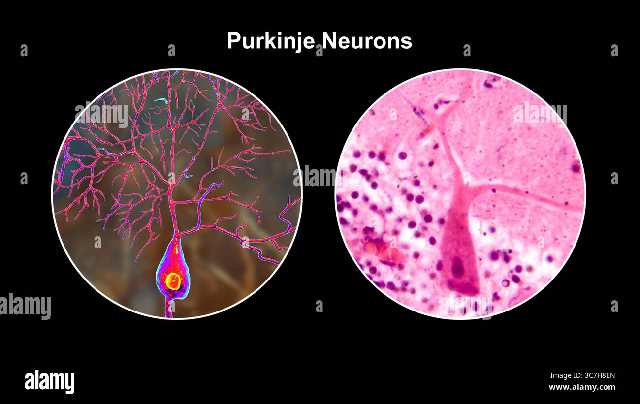 Illustration von Purkinje-Neuronen und eine Lichtmikrographie, die große, verzweigte Neuronen in der Kleinhirnrinde zeigt, die an der motorischen Koordination beteiligt sind und an Ataxien beeinflusst sind. Stockfoto
