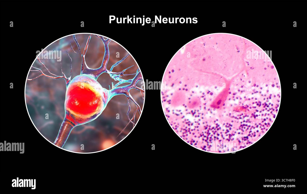 Illustration von Purkinje-Neuronen und eine Lichtmikrographie, die große, verzweigte Neuronen in der Kleinhirnrinde zeigt, die an der motorischen Koordination beteiligt sind und an Ataxien beeinflusst sind. Stockfoto