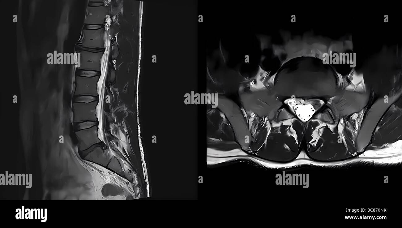 mrt-Scan der Lendenwirbelsäule in sagittaler und transversaler Ansicht. Der Patient hat einen Bandscheibenvorfall zwischen L5 und S1, der zu einer Nervenkompression führt. Untere Rückseite Healt oder Stockfoto