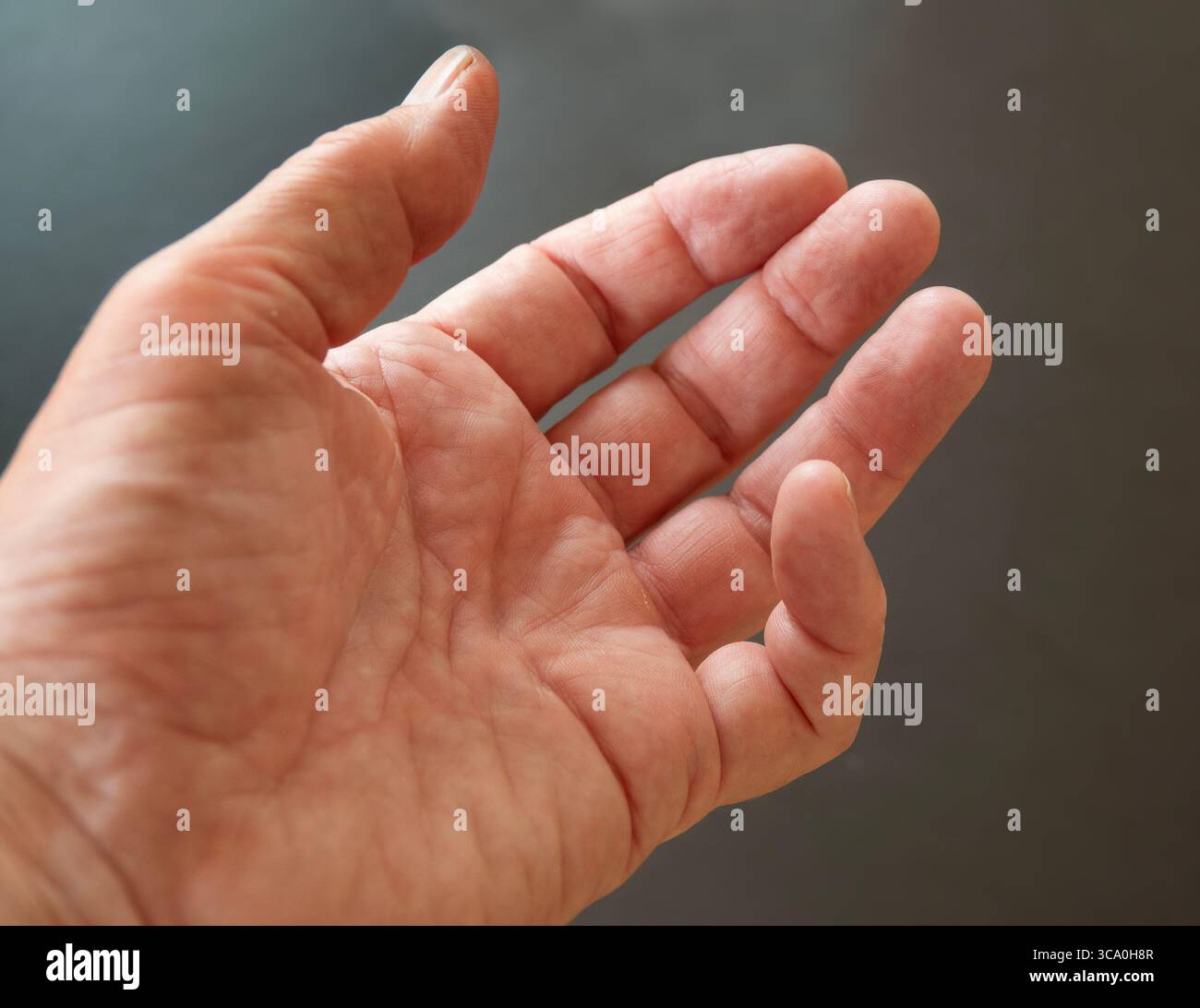Hand einer Person mit Dupuytren-Kontraktur - ein Zustand, bei dem ein oder mehrere Finger dauerhaft in einer gebeugten Position gebogen werden. Kleiner Finger. Stockfoto
