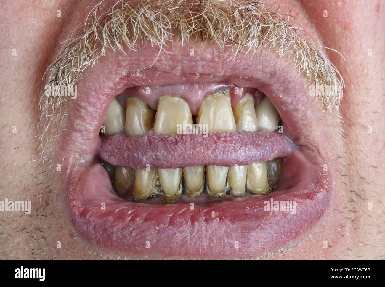 Gelbe Zähne und Schnurrbart, Zunge gebissen und trockene Lippen bei einem älteren Mann Makro. Der Schaden, den der Alkohol und Tabak Konzept. Studio Makroaufnahme Stockfoto