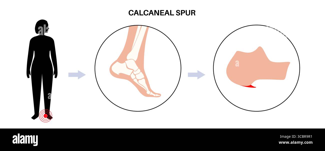 Abbildung eines Fersensporns. Dies ist ein knöchernes Wachstum, das sich am Fersenbein (Calcaneus) entwickeln kann. Viele Menschen mit Fersensporn haben keine Schmerzen, andere können starke Schmerzen und Druckempfindlichkeit in der Ferse haben. Stockfoto