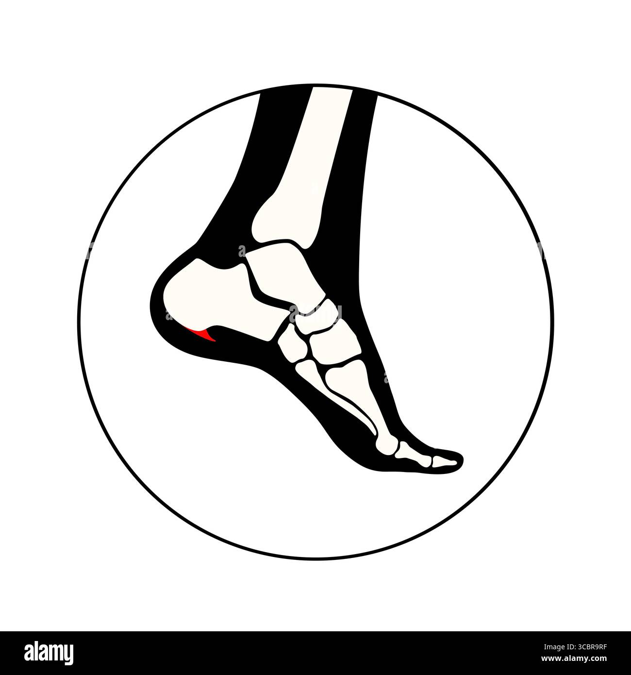 Abbildung eines Fersensporns. Dies ist ein knöchernes Wachstum, das sich am Fersenbein (Calcaneus) entwickeln kann. Viele Menschen mit Fersensporn haben keine Schmerzen, andere können starke Schmerzen und Druckempfindlichkeit in der Ferse haben. Stockfoto