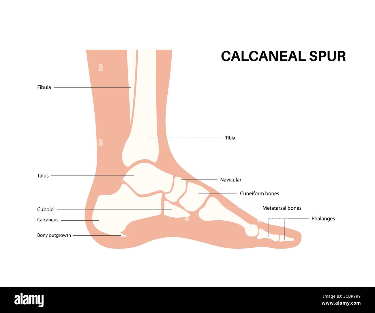 Abbildung eines Fersensporns. Dies ist ein knöchernes Wachstum, das sich am Fersenbein (Calcaneus) entwickeln kann. Viele Menschen mit Fersensporn haben keine Schmerzen, andere können starke Schmerzen und Druckempfindlichkeit in der Ferse haben. Stockfoto