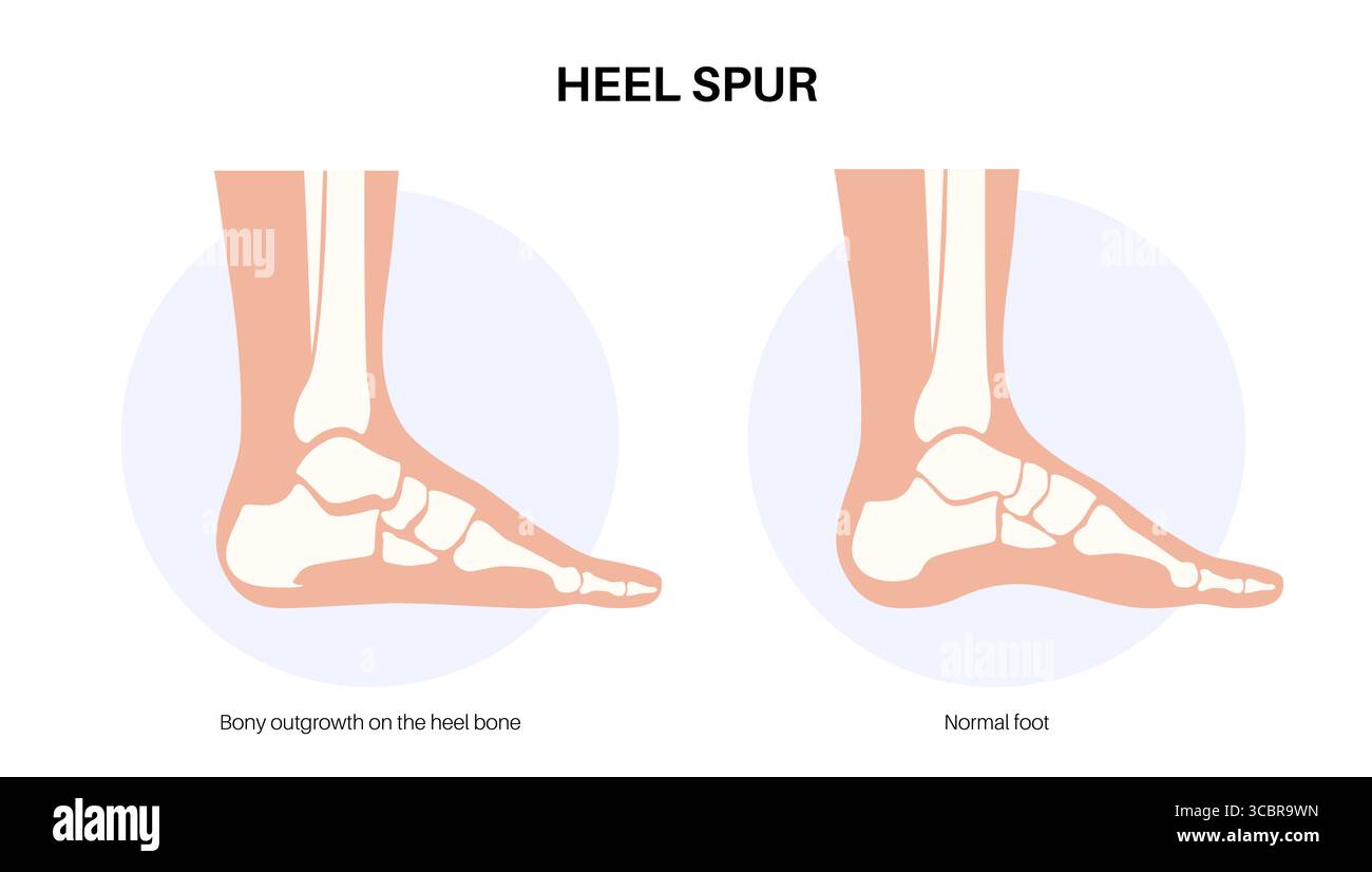 Abbildung eines Fersensporns. Dies ist ein knöchernes Wachstum, das sich am Fersenbein (Calcaneus) entwickeln kann. Viele Menschen mit Fersensporn haben keine Schmerzen, andere können starke Schmerzen und Druckempfindlichkeit in der Ferse haben. Stockfoto