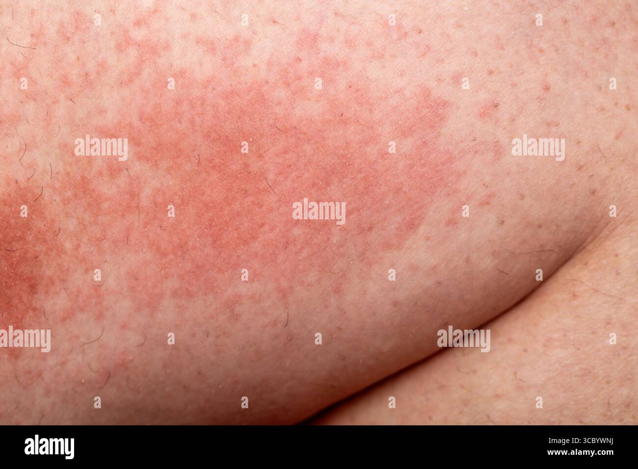 Nahaufnahme allergischer Hautausschlag Dermatitis-Ekzem am menschlichen  Fuss. Bein mit rotem Ausschlag durch Insektenstiche. Dermatitis,  Follikulitis, Pilzinfektion. Betroffenes A Stockfotografie - Alamy