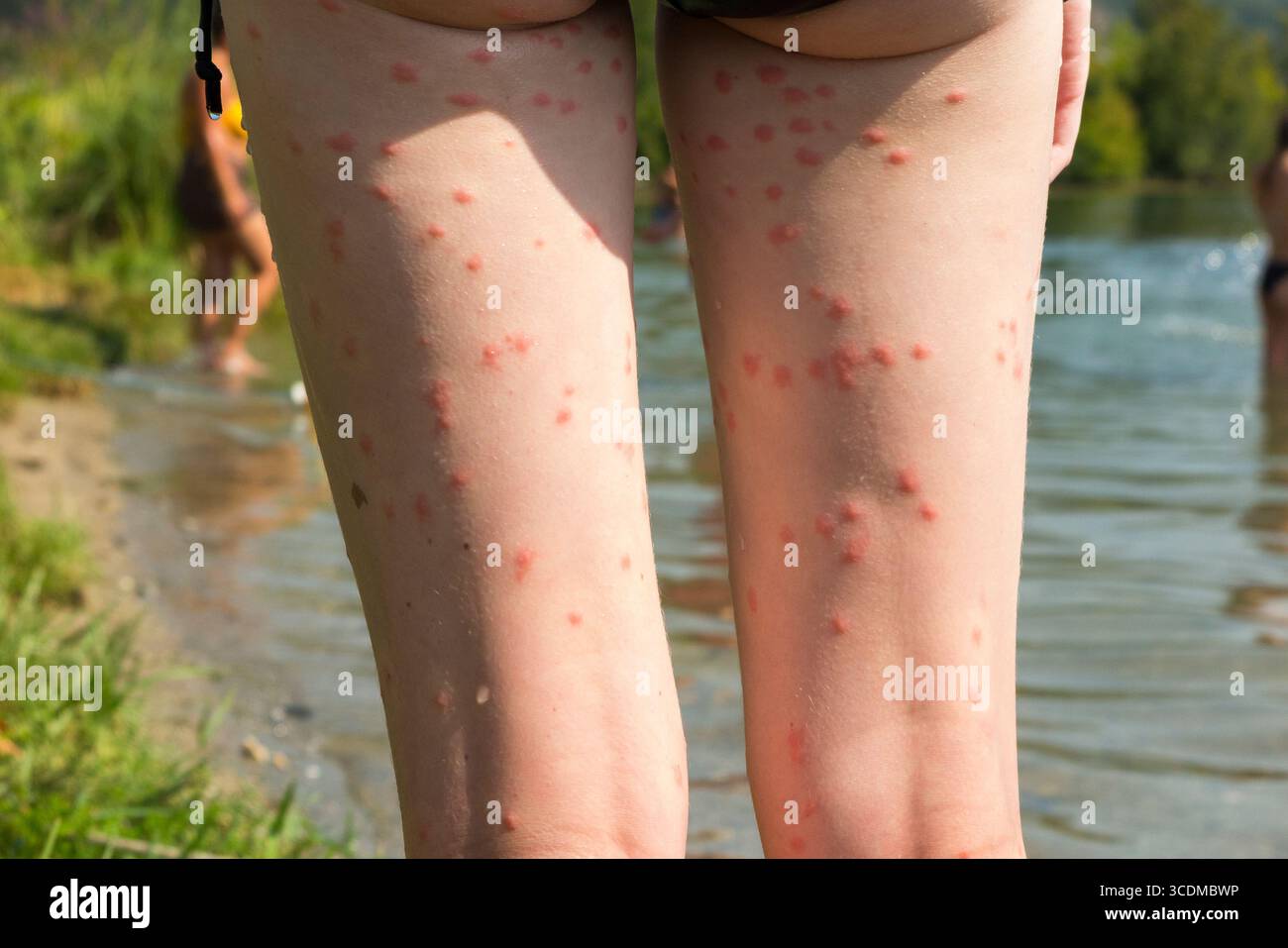 Die Beine eines 13-jährigen Mädchens/Kindes, das nach dem Schwimmen im Lac du Bourget mehrere Hautausbrüche aufgrund von Puces de Canard/Entenflohlarven aufweist. Frankreich. (145) Stockfoto