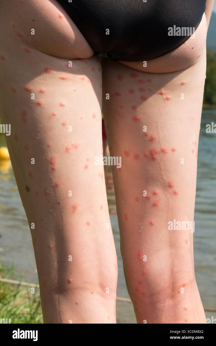 Die Beine eines 13-jährigen Mädchens/Kindes, das nach dem Schwimmen im Lac du Bourget mehrere Hautausbrüche aufgrund von Puces de Canard/Entenflohlarven aufweist. Frankreich. (145) Stockfoto