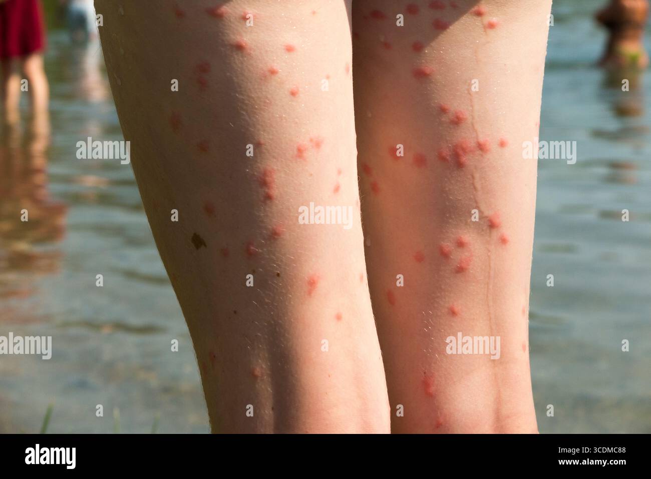 Die Beine eines 13-jährigen Mädchens/Kindes, das nach dem Schwimmen im Lac du Bourget mehrere Hautausbrüche aufgrund von Puces de Canard/Entenflohlarven aufweist. Frankreich. (145) Stockfoto